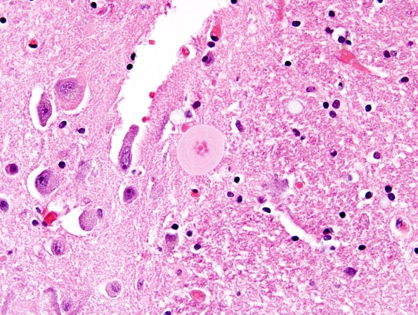 3A2 DLBD (Case 3) L8 Thalamus 60X match A H&E.jpg