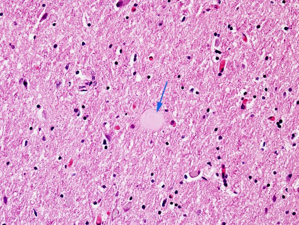 3A3 DLBD (Case 3) L8 Thalamus H&E 3 copy.jpg