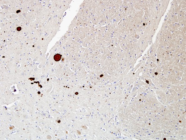 3B1 DLBD (Case 3) L8 Thalamus 20X match C pSYN.jpg