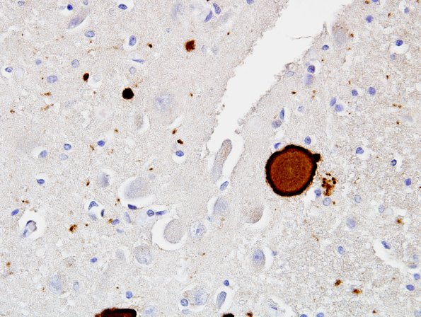 3B2 DLBD (Case 3) L8 Thalamus 60X match A pSYN.jpg