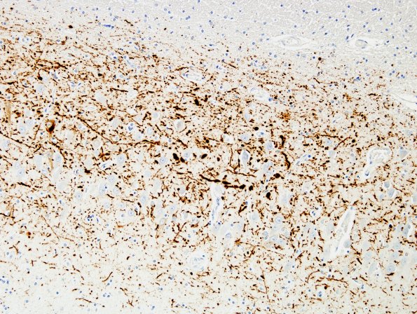 3C3 DLBD (Case 3) Entorhinal pSYN