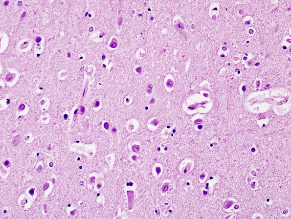 4A1 DLBD (Case 4) Cingulate H&E 5