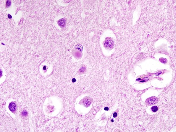 4A2 DLBD (Case 4)) Cingulate H&E 7