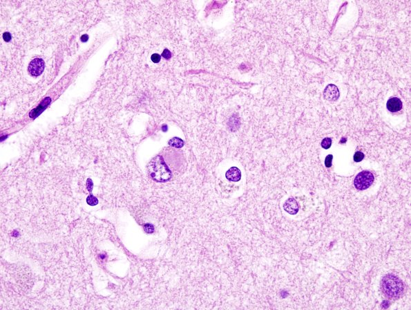 4A3 DLBD (Case 4)) Cingulate H&E 3