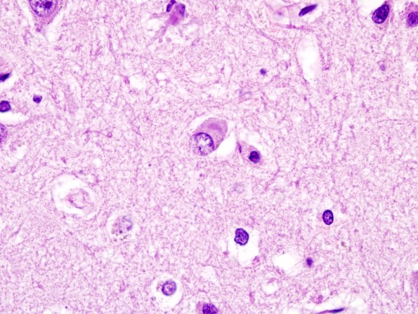 4A4 DLBD (Case 4)) Cingulate H&E 4