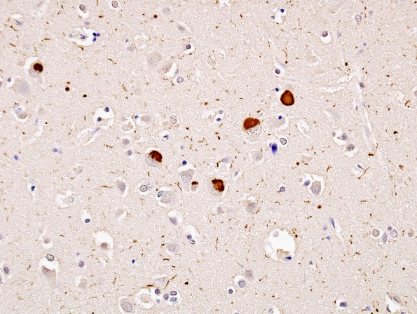 4B1 DLBD (Case 4)) Cingulate pSYN 3