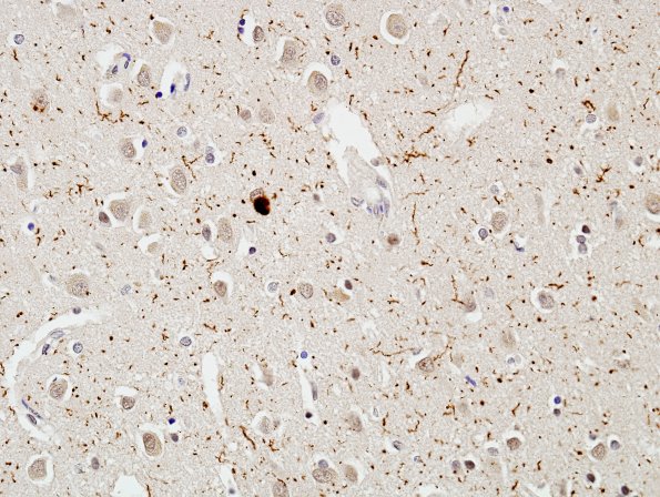 4B2 DLBD (Case 4)) Cingulate pSYN 2