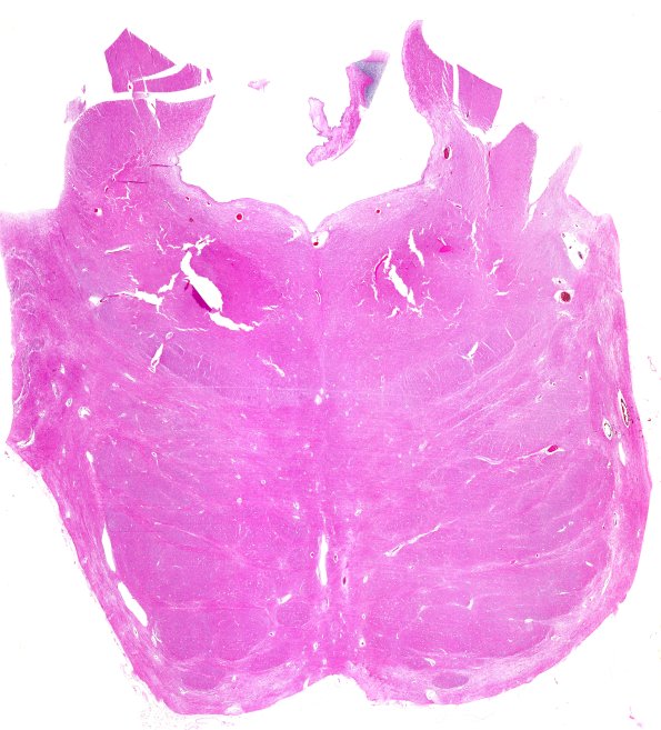 10C1 MSA (Case 10) N16 H&E WM 2