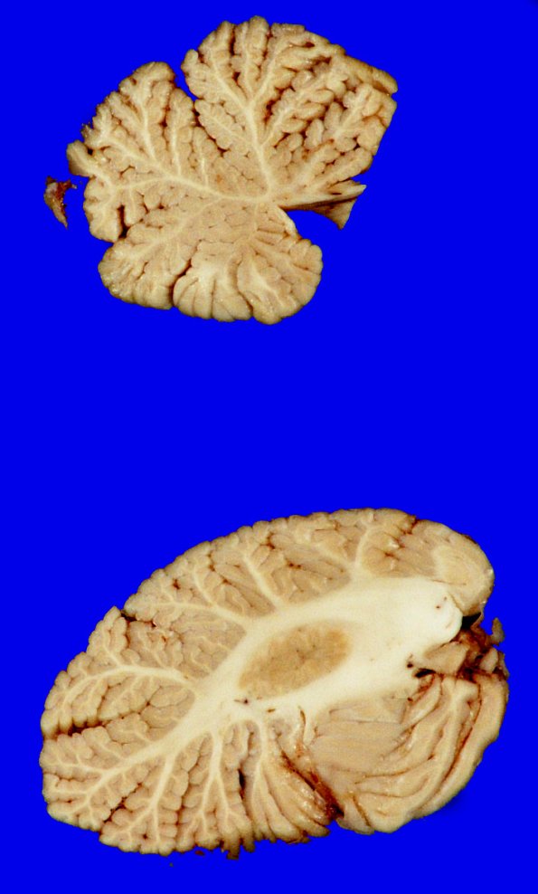 11A5 MSA (Case 11) Gross_3