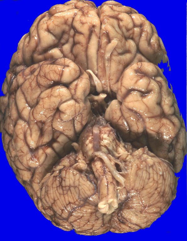 12A1 MSA (Case 12) _1