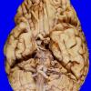 13A1 Multiple systems atrophy (MSA, Case 13) 2