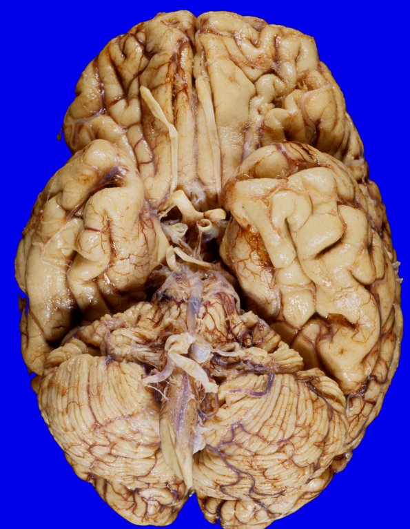 13A1 Multiple systems atrophy (MSA, Case 13) 2