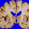 13A2 Multiple systems atrophy (MSA, Case 13) 1