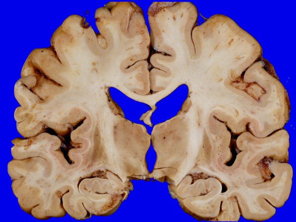 13A2 Multiple systems atrophy (MSA, Case 13) 1