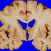 13A3 Multiple systems atrophy (MSA, Case 13) 3