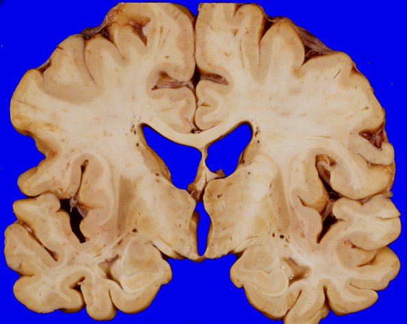 13A3 Multiple systems atrophy (MSA, Case 13) 3