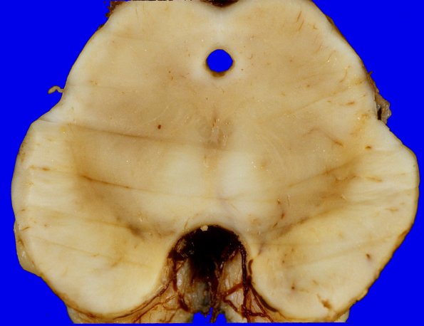 13A5 Multiple systems atrophy (MSA, Case 13) 4