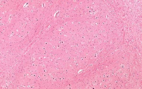 13E1 MSA (Case 13) N8 H&E olive 10X