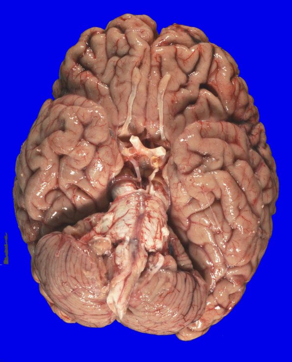 14A1 MSA (SND, Case 14) 1