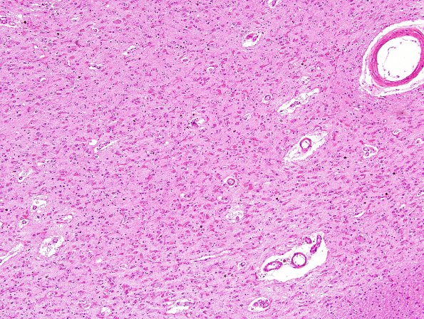 14B2 MSA (SND, Case 14) L6 devastated putamen H&E 2.jpg