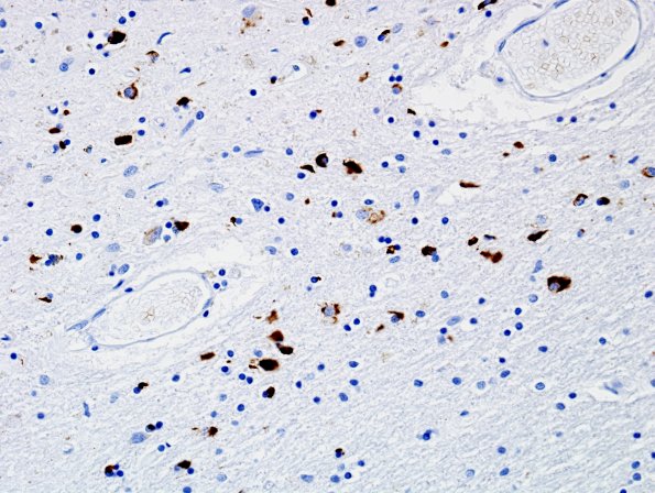 14C MSA (SND, Case 14) L6 pSYN devastated area.jpg