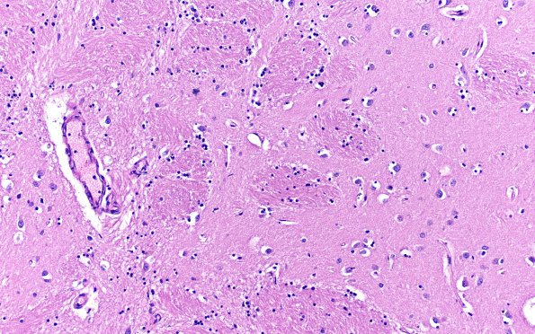 16B1 MSA (Case 16) H&E L17 20X