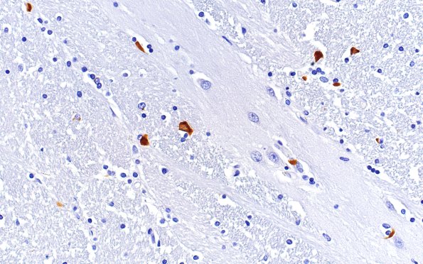 16C MSA (Case 16) psyn L17 40X