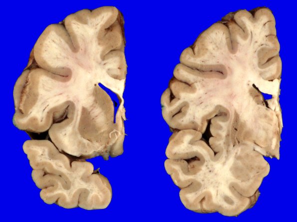 1A6 MSA (Case 1) Gross_11