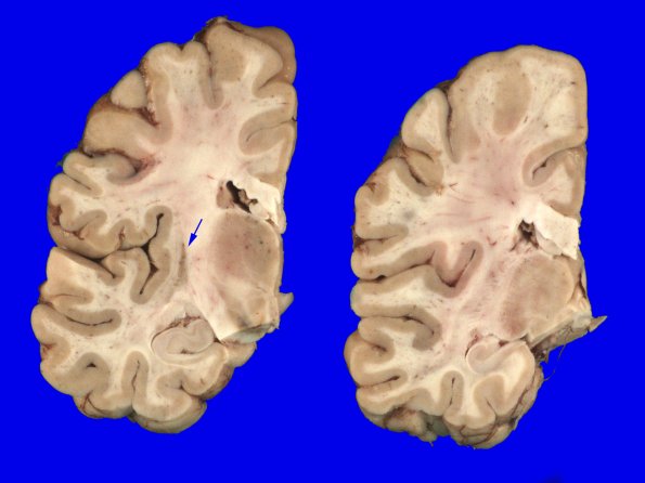 1A7 MSA (Case 1) Gross_12 copy