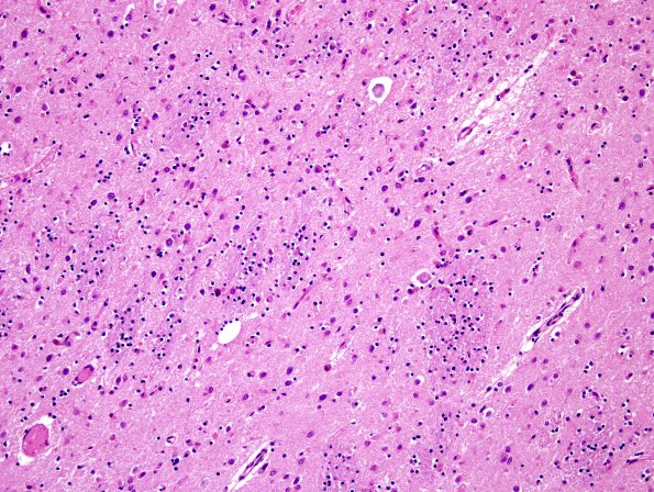 1B3 MSA (Case 1) Caudate-Putamen H&E 7