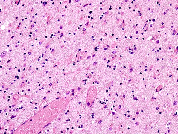 1B4 MSA (Case 1) Caudate-Putamen H&E 11