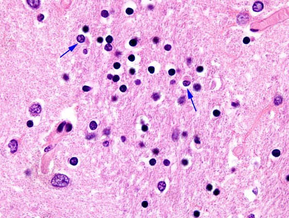 1B5 MSA (Case 1) Caudate-Putamen H&E 100X 3 copy