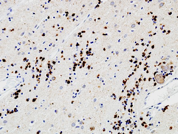 1C2 MSA (Case 1) Caudate-Putamen pSYNuclein 5