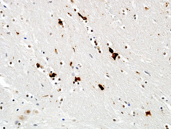 1D1 MSA (Case 1) Pons pSYNuclein 19