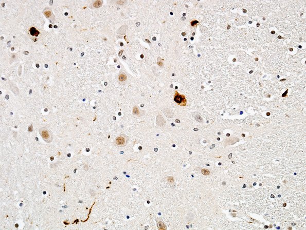 1D3 MSA (Case 1) Pons pSYNuclein 22