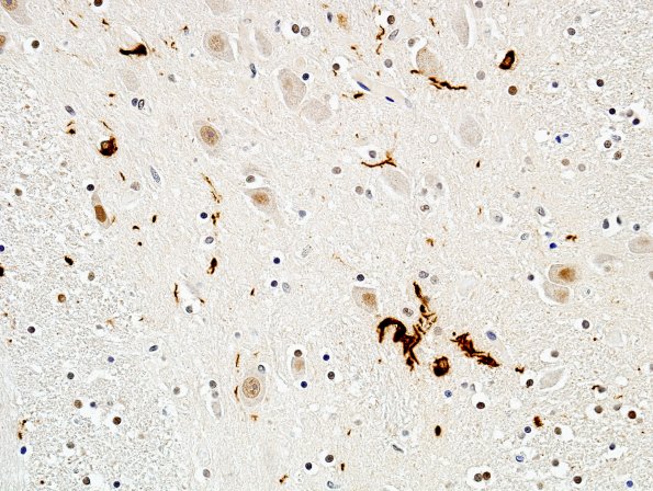 1D4 MSA (Case 1) Pons pSYNuclein 23