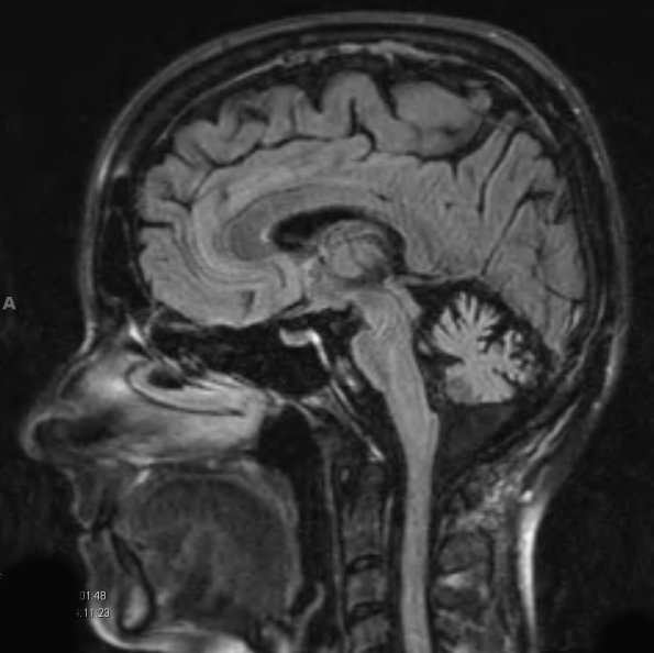 20A1 MSA (Case 20) FLAIR T2 - Copy - Copy