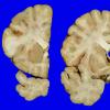 21A1 Multiple Systems Atrophy (Case 21) 6