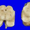 21A2 Multiple Systems Atrophy (Case 21) 4