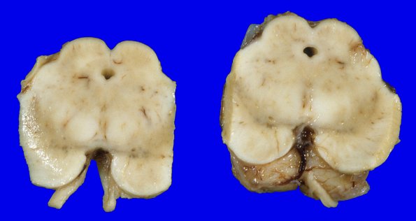 21A2 Multiple Systems Atrophy (Case 21) 4