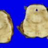 21A3 Multiple Systems Atrophy (Case 21) 3