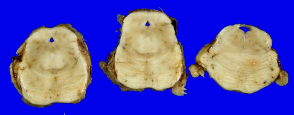 21A3 Multiple Systems Atrophy (Case 21) 3