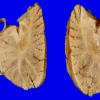 21A4 Multiple Systems Atrophy (Case 21) 2