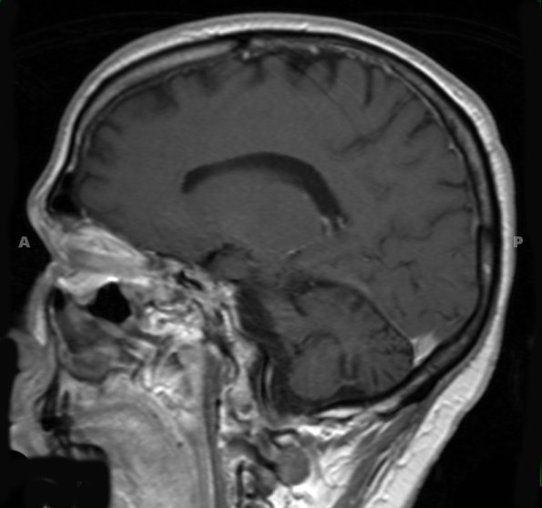 2A3 MSA (Case 2) T1 W - Copy