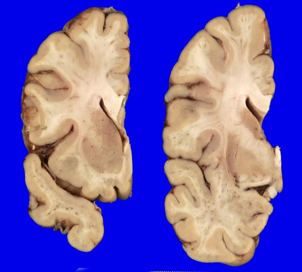 2B2 MSA (Case 2) Gross _21