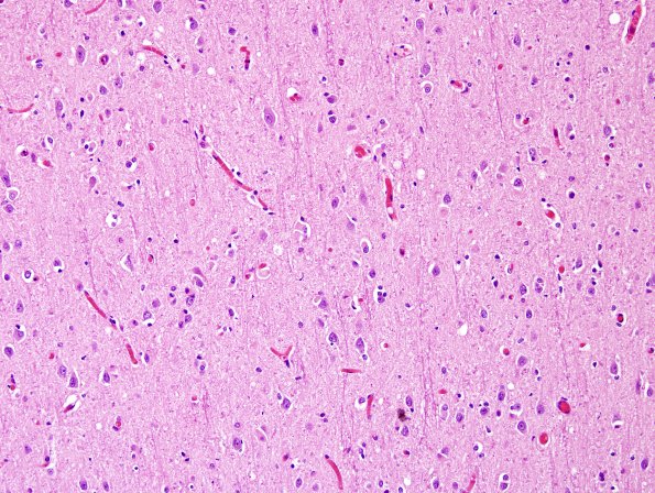 2C2 MSA (Case 2) L21 Precentral gyrus H&E 17