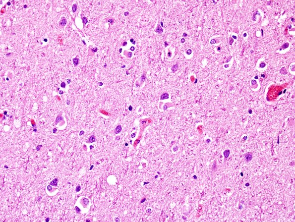 2C3 MSA (Case 2) L21 Precentral gyrus H&E 26