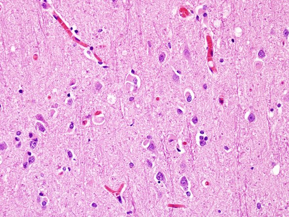 2C4 MSA (Case 2) L21 Precentral gyrus H&E 19