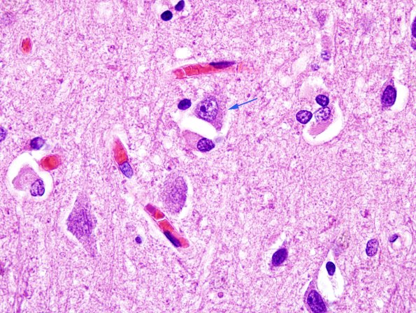 2C5 MSA (Case 2) L21 Precentral gyrus H&E 8 copy