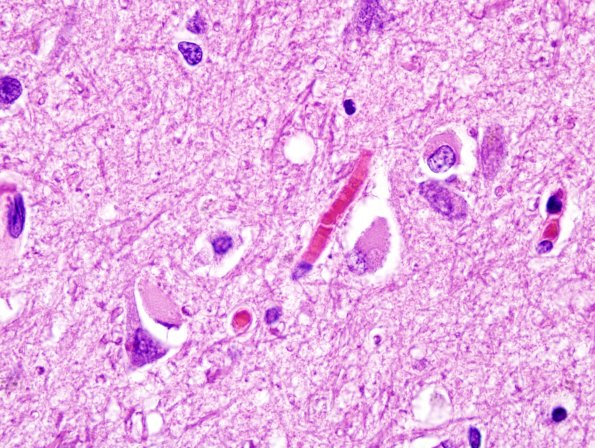 2C6 MSA (Case 2) L21 Precentral gyrus H&E 3